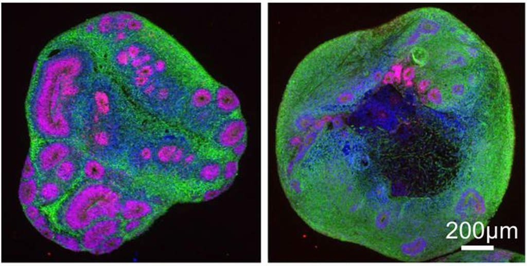 Kürzliche Fortschritte ermöglichen es, Neuronenstrukturen dreidimensional zu züchten. Es entsteht ein Minigehirn. In dieser Studie wurden an solchen Minigehirnen mit der juvenilen Form der Huntington-Krankheit (rechts) geringere und kleinere interne Strukturen festgestellt, hier pink eingefärbt, als bei Minigehirnen ohne die Huntington-Genmutation (links).  