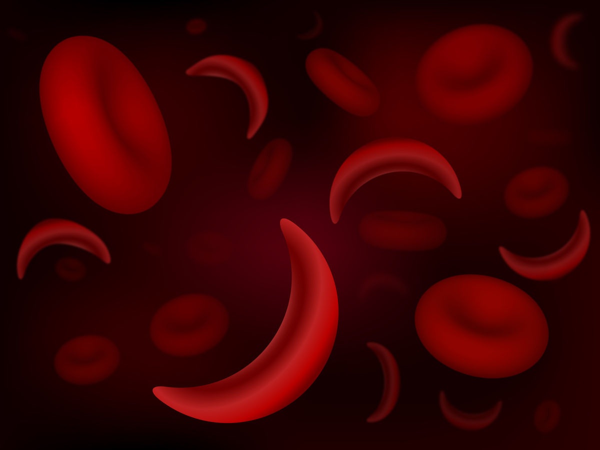 Die Sichelzellenanämie führt dazu, dass rote Blutkörperchen eine „C“- oder Sichelform annehmen. Menschen mit dieser Krankheit fehlt ein Protein, das den roten Blutkörperchen eine starre Form verleiht, die ihnen hilft, Sauerstoff durch den Körper zu transportieren. Weniger Sauerstoff bedeutet, dass Menschen mit Sichelzellenanämie weniger rote Blutkörperchen haben und unter verstopften Blutgefäßen und möglicherweise einem Schlaganfall leiden können.  