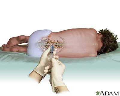 Das ASO-Medikament wurde bei ALS-Patienten mit einem Verfahren ähnlich einer Lumbalpunktion ins Rückenmark injiziert. Nicht gerade ein Spaziergang, aber ein bisschen einfacher als die Gehirn-Chirurgie, die für andere "Varianten" der Gen-Stummschaltung erforderlich sein könnte.