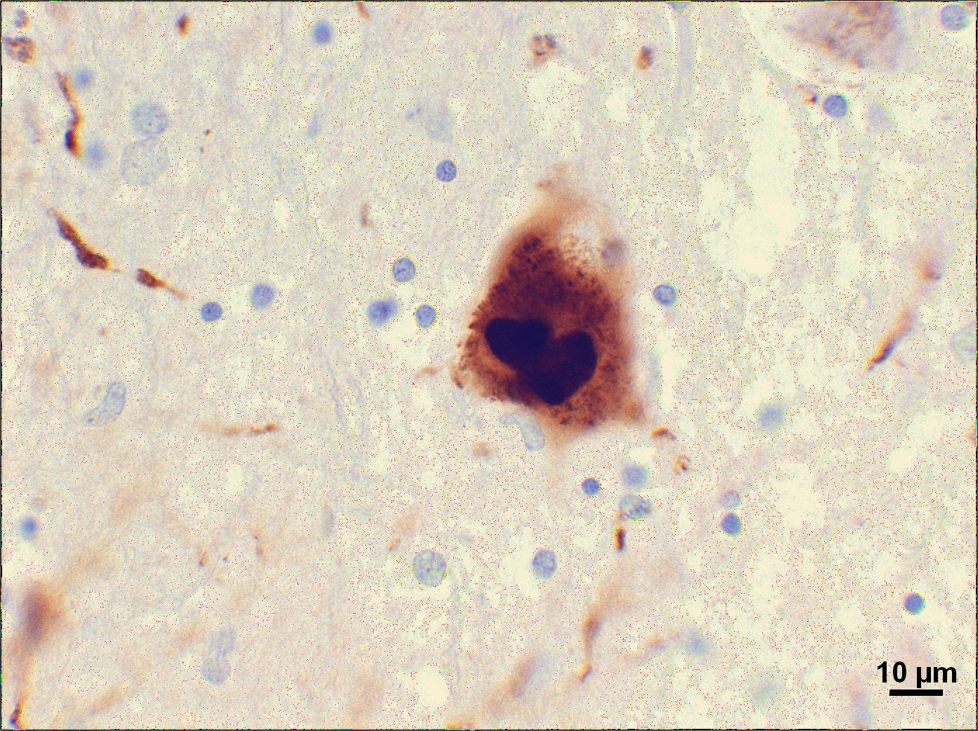 In den Gehirnen von Parkinson Patienten findet man Proteinkumpen, sogenannte 'Lewy Körperchen'. Neuere Arbeiten lassen vermuten, dass diese Müllklumpen auch in neuen, jungen Zellen die in die Gehirne von PK Patienten transplantiert wurden zu finden sind.