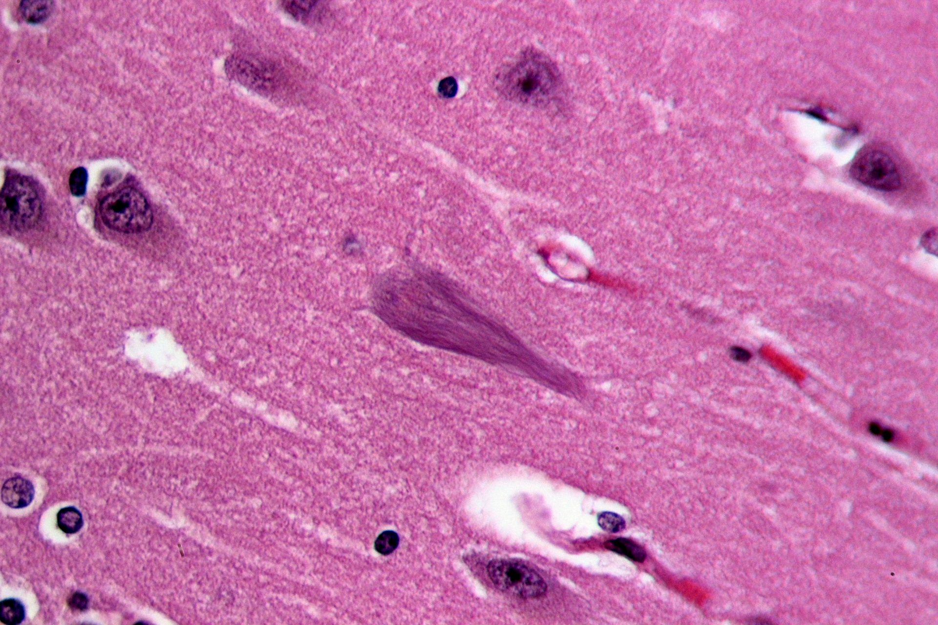 Die Linien in der Gehirnzelle in der Mitte dieses Bildes vom Gehirn eines Alzheimer-Patienten bestehen aus verhedderten Tau-Proteinen. Ein neues Werk bei Alzheimer legt nahe, dass verheddertes Tau von einer Gehirnzelle zur anderen springen kann.