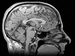 Das größte Volumen, welches das Gehirn jemals erreicht, ist möglicherweise kleiner bei Männern, welche die HD Mutation tragen.  