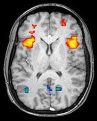 Ein Beispiel für ein fMRT Bild - Regionen, die zu einer bestimmten Zeit aktiv sind (Rot), können von weniger aktiven (Blau) unterschieden werden. Diese Art von Bildern, hilft Wissenschaftlern abzubilden, welche Teile des Gehirns verwendet werden, wenn eine Person ein Problem lösst.  