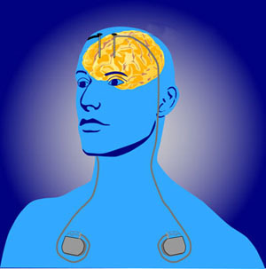 Tiefenhirnstimulation beinhaltet dünne Elektroden, die durch die Schädeldecke ins Gehirn gelegt werden. Die Impulsgeber unter der Haut liefern elektrische Impulse zum Gehirn.  