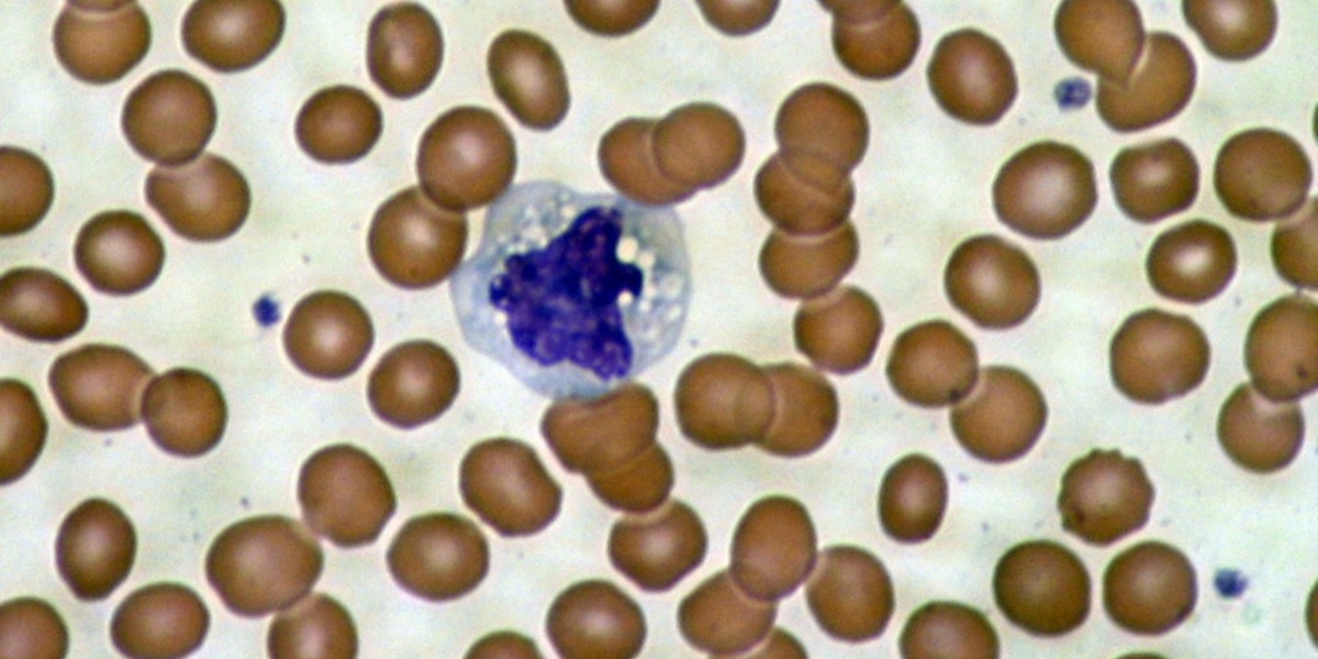 Erleuchtende Erkenntnisse in Blutzellen von Huntington Patienten