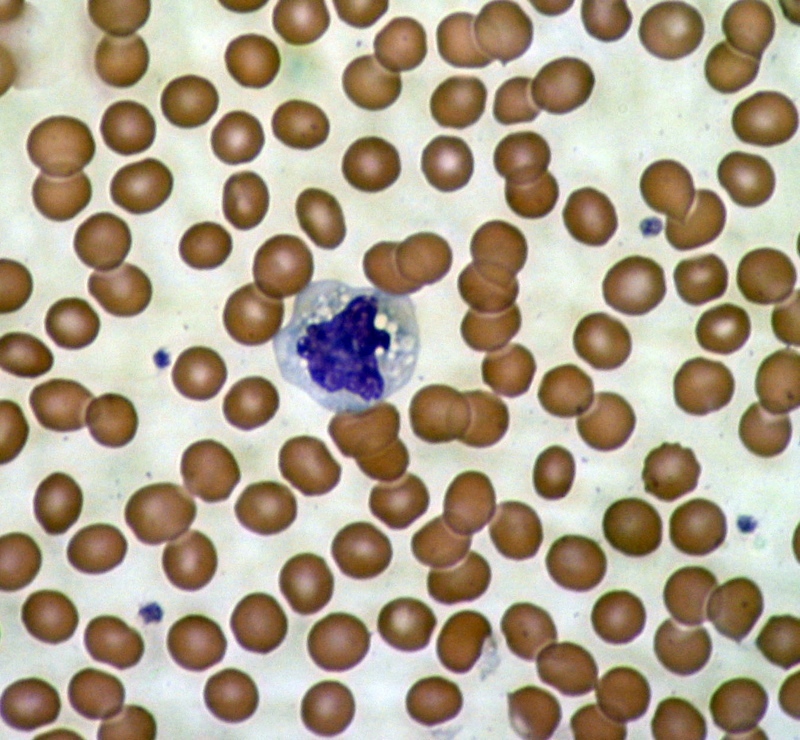 Ein mikroskopisches Bild der Blutkörperchen - rote Blutkörperchen umgeben eine einzelne Zelle des Immunsystems.   