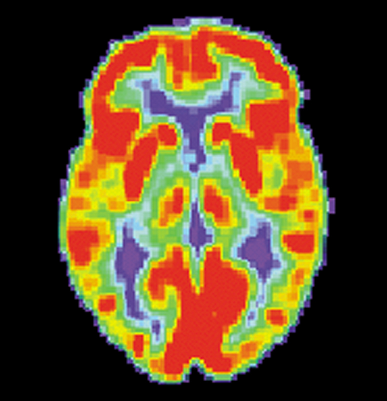 FDG-PET-Scans ermöglichen es uns zu sehen, wie viel Zucker jeder Teil des Gehirns verwendet. Dies ist ein Scan von einem gesunden Gehirn. Die roten Flächen verbrauchen den meisten Zucker.  