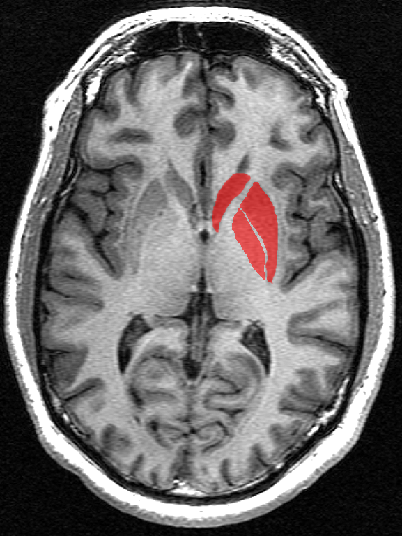 Die Basalganglien (in rot) sind eine Gruppe von Strukturen tief unter der Oberfläche des Gehirns. Diese Hirnregionen sind seit langem dafür bekannt, die größten Schäden im Verlauf der HK zu erleiden.   