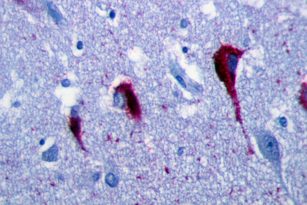 So sehen Tau Proteine aus, wenn sie im Gehirn von Alzheimerpatienten 'Neurofibrillenbündel' bilden. Tau ist nach dem griechischen Buchstaben 'T' benannt.  