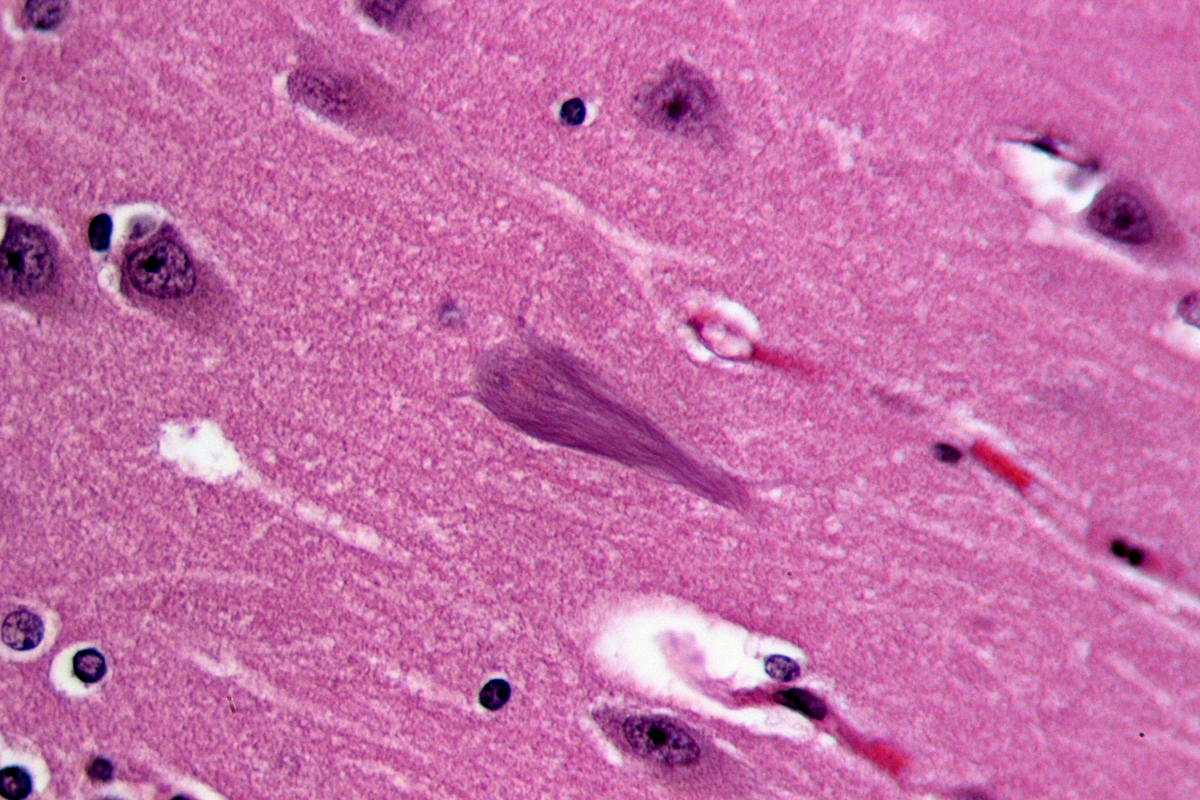 Die Linien in der Gehirnzelle in der Mitte dieses Bildes vom Gehirn eines Alzheimer-Patienten bestehen aus verhedderten Tau-Proteinen. Ein neues Werk bei Alzheimer legt nahe, dass verheddertes Tau von einer Gehirnzelle zur anderen springen kann.   